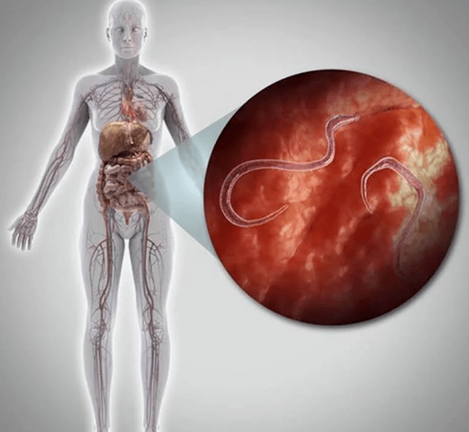 Παράσιτα στο ανθρώπινο σώμα