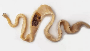 Πώς να ανακαλύψετε την παρουσία παρασίτων στο σώμα